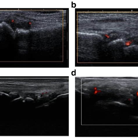 Relation Between The Gray Scale Ultrasound Scan And Doppler Flow Signal