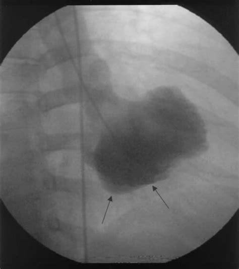 True Aneurysm Of The Left Ventricular Inferior Wall The Arrows