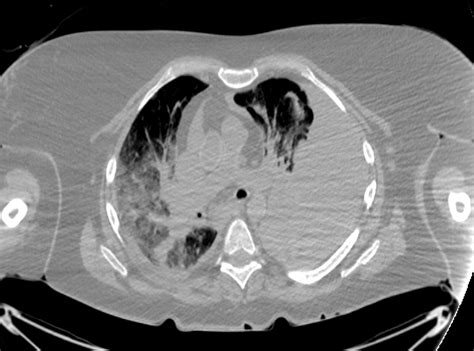 Postmortem Ct Angiography Compared With Autopsy A Forensic Multicenter