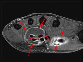 MRI Musculo-Skeletal Section: Classic horseshoe abscess.