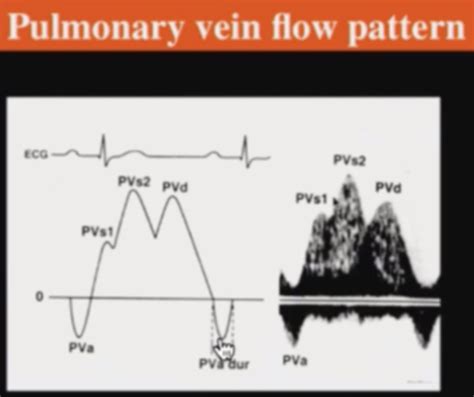 Doppler Echocardiography And Hemodynamics Flashcards Quizlet