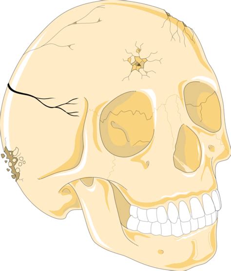 Depressed Skull Fracture Symptoms Treatment Sanjay Hospital