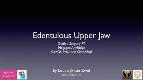 Guided Surgery R Lite By Dr Lodewijk Van Zwol Megagen