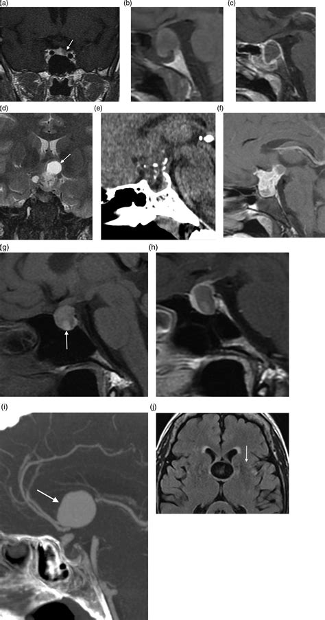 Sellar Suprasellar And Parasellar Masses Imaging Features And