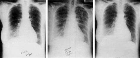 A C A Left Chest Roentgenogram Of The Patient In Case Four Weeks