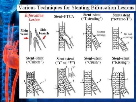 A Case Of Bifurcation Stenting Dr Zarrar