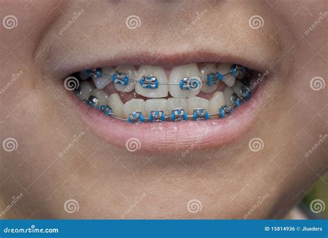 Light blue braces - qualityfiln