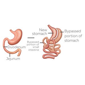 Best Bariatric Surgery Centre In Ahmedabad India Asian Bariatrics