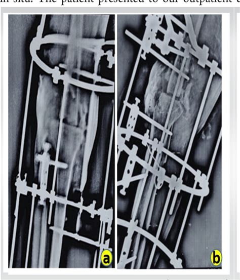 Pdf Case Of Infected Non Union Of Distal Femur Treated With Ilizarov