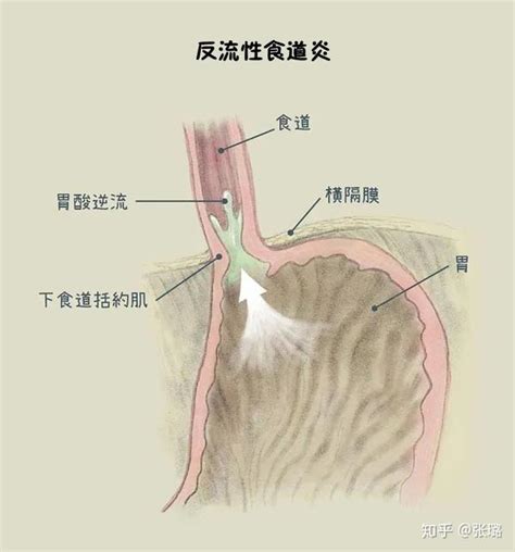 专栏反流性食管炎6大原因，避开10种地雷饮食 知乎