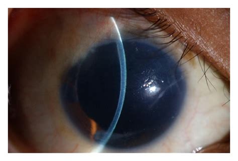 What Is Corneal Edema And How To Manage It Obn