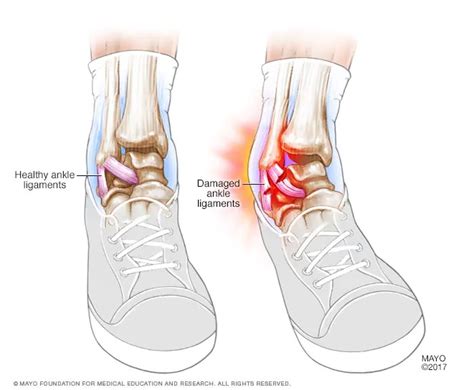 Ankle Sprain Causes Symptoms And Treatment In Singapore Ray Of Health