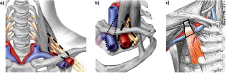 Brachial Plexus Compression Test Physiopedia