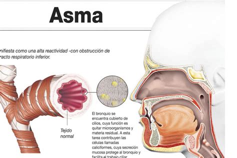 Infografía Asma Lupa Ediciones