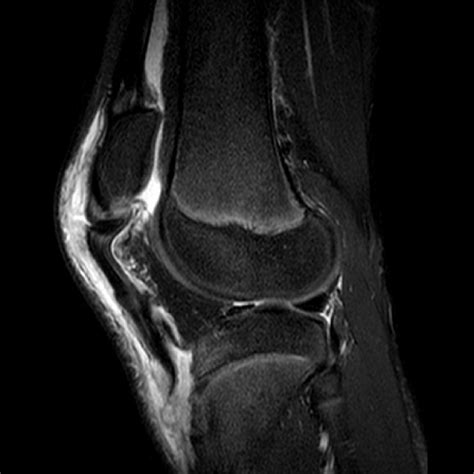 Preoperative sagittal MRI demonstrating bifocal avulsion sleeve ...