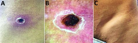 figure eschar  inoculation  lymphadenopathy  patient