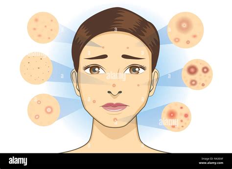 Severe Acne Stock Vector Images Alamy