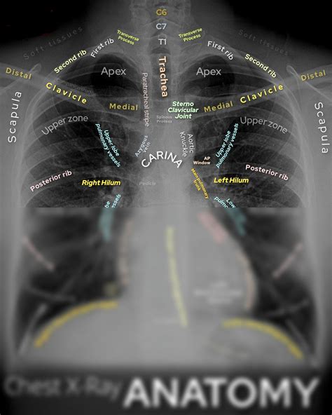 SOLUTION: Chest xray anatomy - Studypool