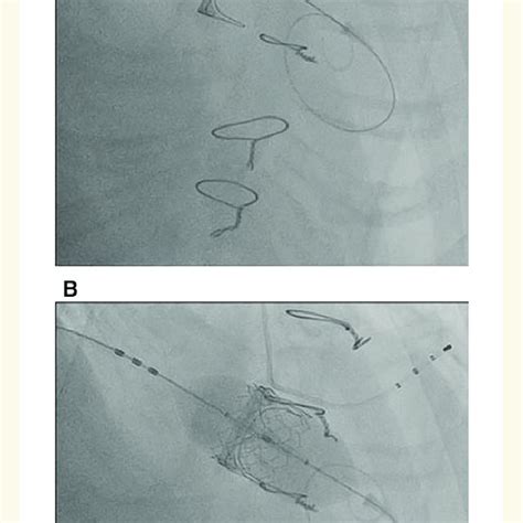 Fluoroscopic Image Shows 26 Mm Sapien 3 Valve Aligned In Carpentier