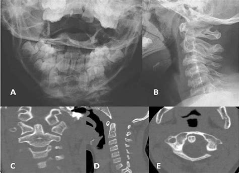 Typical Torticollis Position Of Atlantoaxial Rotatory Displacement The