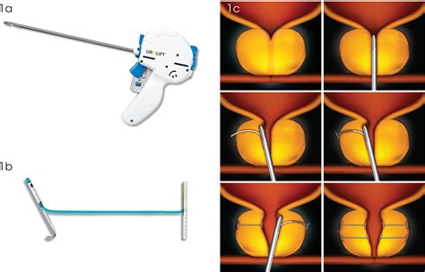 The Urolift System A Progress Report Mcnicholas 2020 Trends In Urology And Mens Health