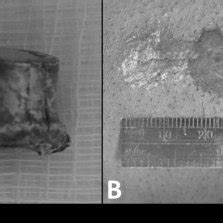 (A) Photograph of the extracted bullet fragment and (B) photograph of ...