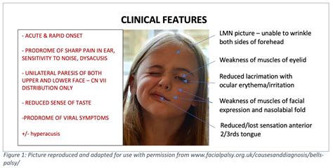 The Droopy Dribbler Paediatric Presentations Of Bells Palsy Rcemlearning India