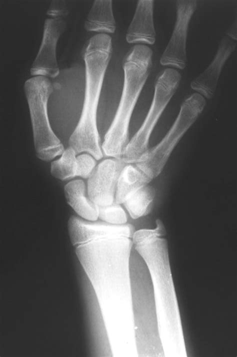 Scaphoid Fracture Avascular Necrosis