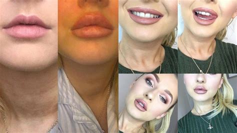 Lip Injection Pics Before And After Sitelip Org