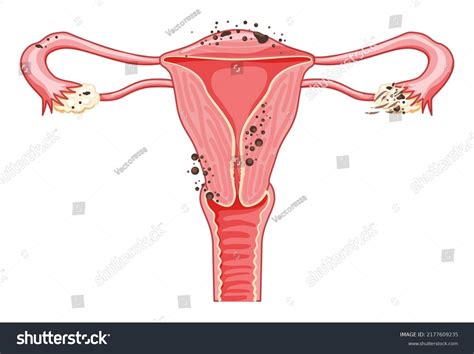 Endometriosis Stages Female Reproductive System Pain Stock Vector