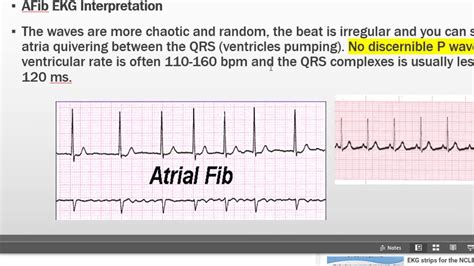 Nursing Nclex Ekg Part 2 Atrial Fib Fluttter V Tach V Fib