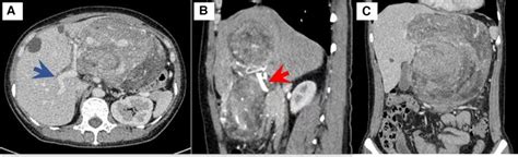 Frontiers A Rare Case Of Giant Hepatic Angiomyolipoma With