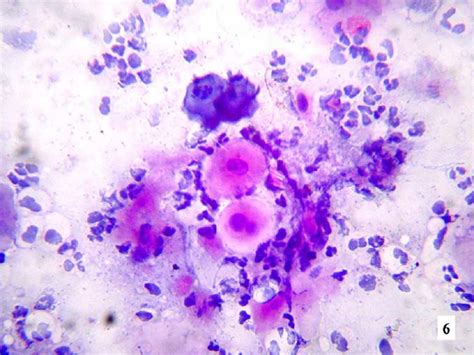 Buccal Mucosa Squamous Cell Carcinoma