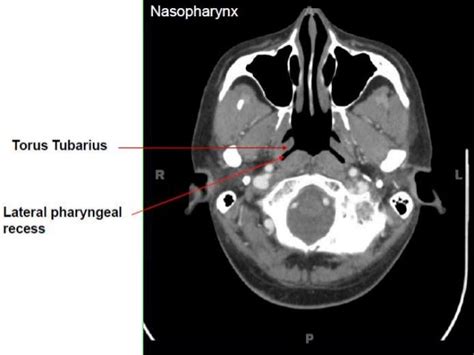 Nasopharynx Ct