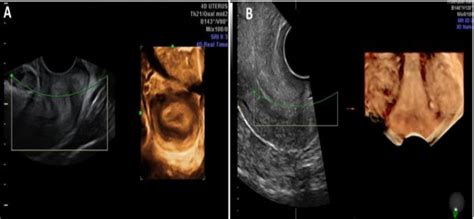 Role Of Three Dimensional Ultrasound In Uterine Anomalies 3d