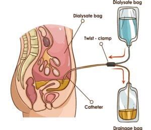 Tenckhoff Catheter And Peritoneal Dialysis Oscestop Osce Learning