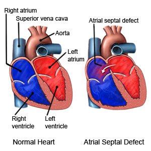 Congenital Heart Defects Facts About Atrial Septal Defects, 40% OFF