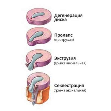 Экструзия и протрузия дисков в чем разница