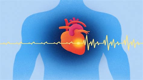 Atrial Fibrillation Causes, Complications, And Treatment Approaches ...