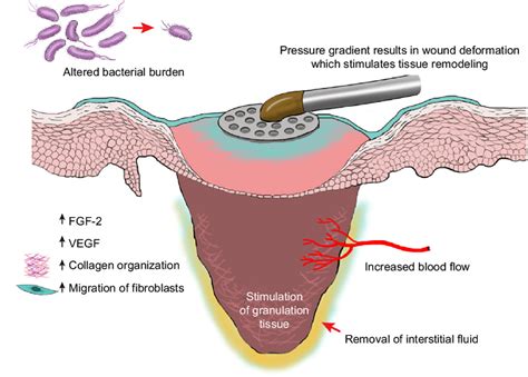 Global Negative Pressure Wound Therapy Industry Is Expected To