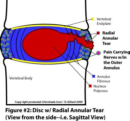 Annular Tear Surgery - AKSIS Special Hospital