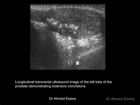 Imaging Prostatitis Urethritis Dr Ahmed Esawy Ppt