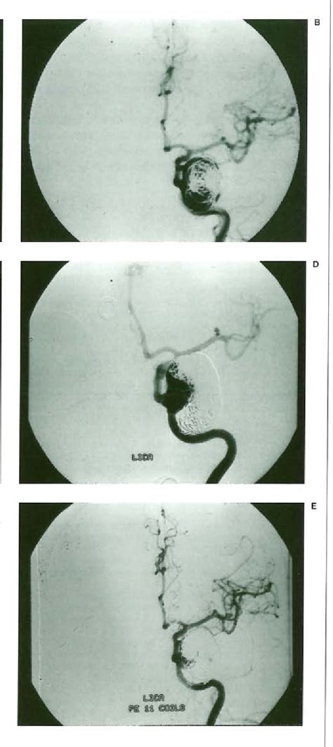 Figure From Gdc Embolisation Of Cavernous Internal Carotid Artery