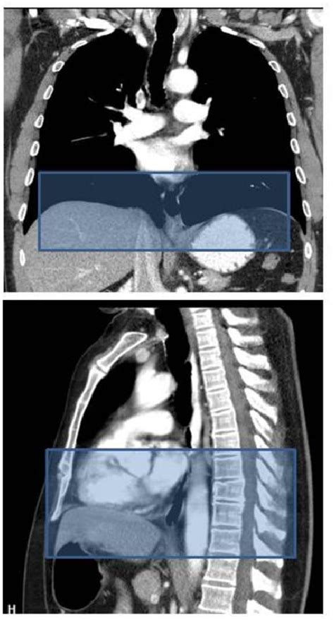 Figure 2 From Esophageal Cancer Anatomical Features Current