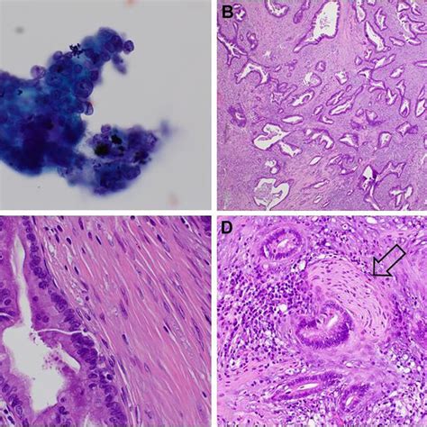 Pancreatic Adenocarcinoma A Endoscopic Ultrasound Guided With