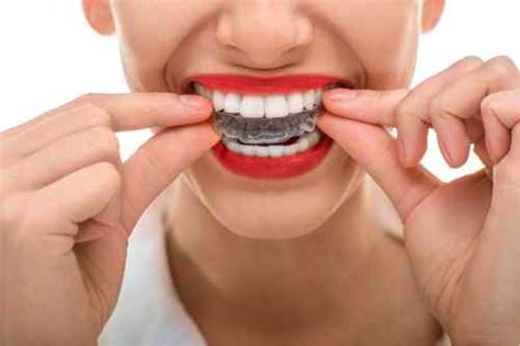 Invisalign Una Ortodoncia Invisible