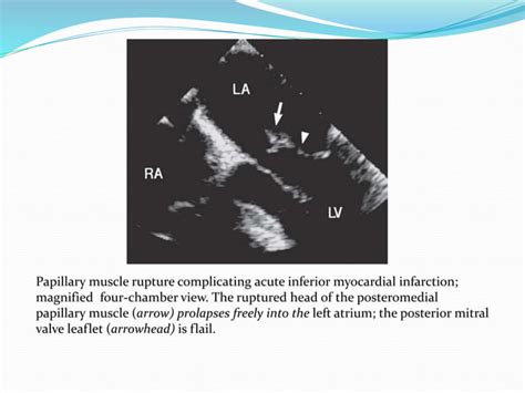 Complications of acute mi