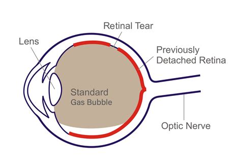 Retinal Detachment Dr Rehman Siddiqui