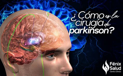 C Mo Es La Cirug A Para Parkinson Centro Cl Nico Fenix Salud