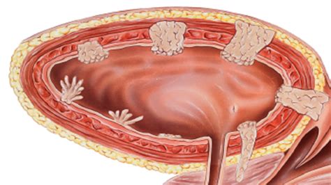 New Concepts In Managing Advanced Urothelial Cancer MyCME